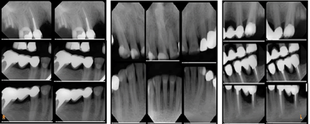 Journal-Dental-Craniofacial-Research-Periapical