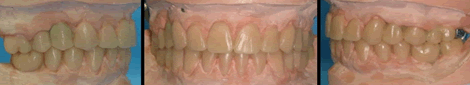 Journal-Dental-Craniofacial-Research-wax-up