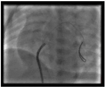 ipipc-23-Coronary