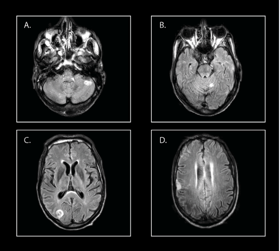 Subarachnoid Hemorrhage Following Anticoagulation Therapy in a Patient ...