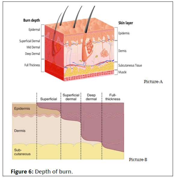 pediatric-care-burn