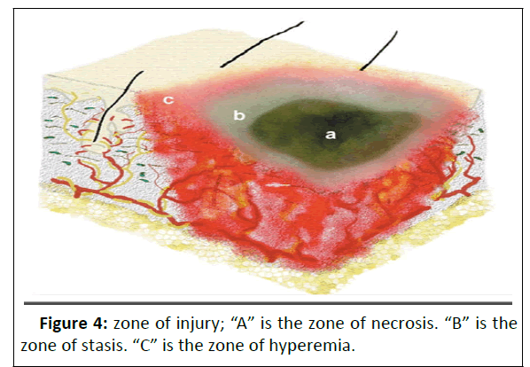 pediatric-care-necrosis