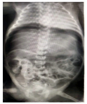 pediatric-emergency-pneumoperitoneum