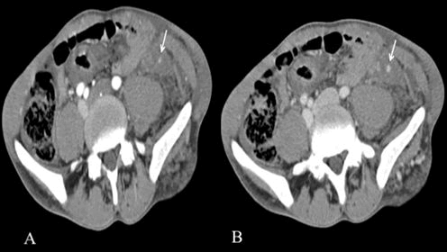 trauma-acute-angiography