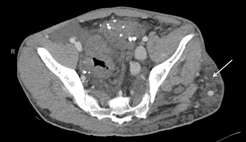 trauma-acute-hemangiomat