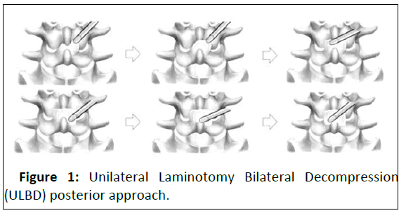 ipsr-Unilateral