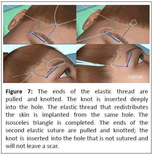 aesthetic-elastic-thread