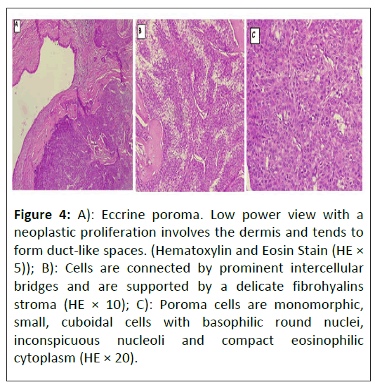 critical-care-neoplastic-proliferation