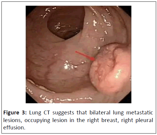 medical-case-bilateral-lung