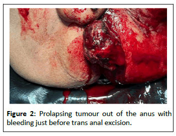 medical-case-prolapsing-tumour