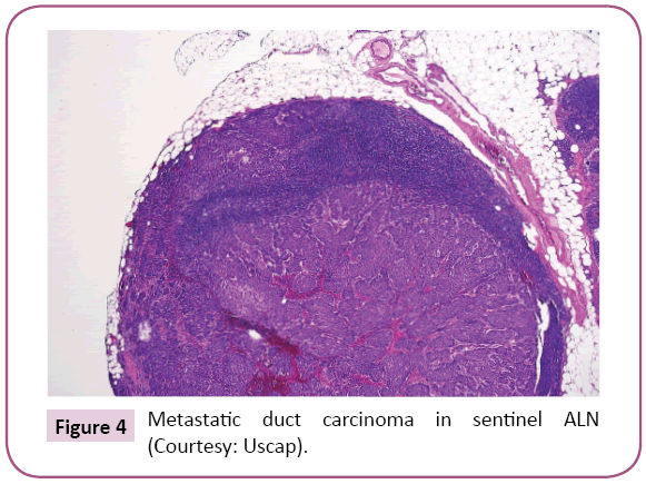 biology-medical-research-Metastatic-duct