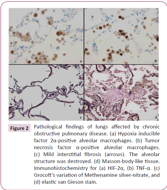 chronic-obstructive-pulmonary-disease-Gieson-stain