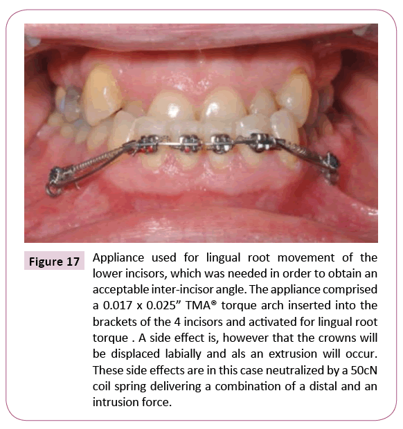 dental-craniofacial-research-Appliance-used