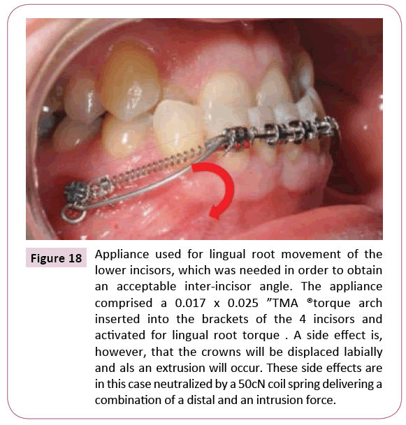 dental-craniofacial-research-Appliance-used