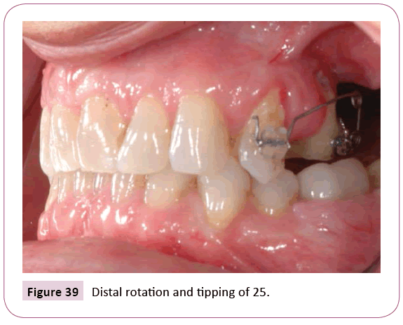 dental-craniofacial-research-Distal-rotation