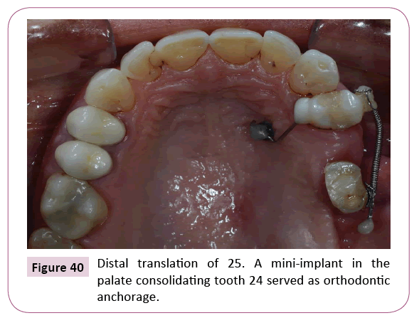 dental-craniofacial-research-Distal-translation