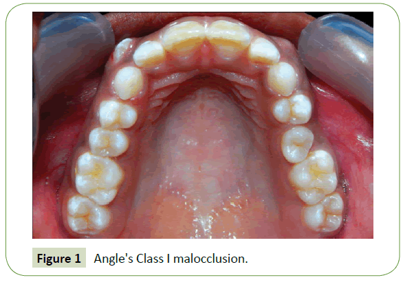 medical-research-health-education-Angles-Class-malocclusion